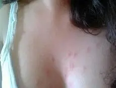 【女性性病图片】_症状_图片_苹果绿