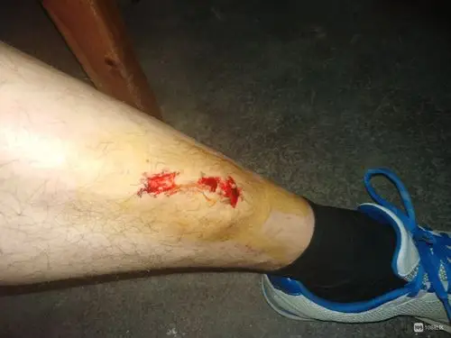 甘霖散步车子远光灯照过来!我双脚踏空掉进窨井,腿上出血