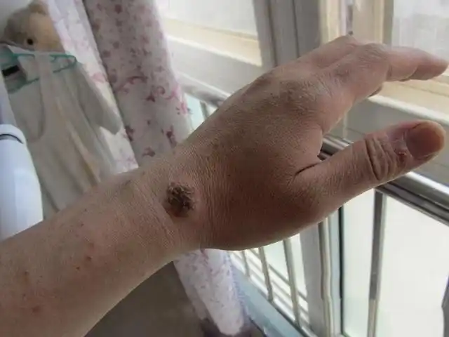 儿童牛皮肤癣的症状图片