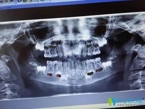 儿童牙片显示图