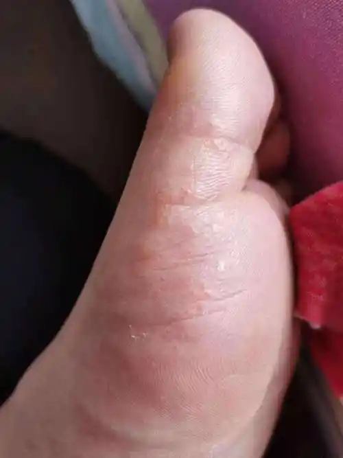 脚上起小水泡很痒是怎么回事?是湿气重吗?