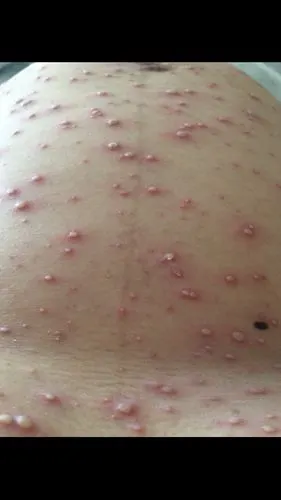 被传染水痘,还发烧了……希望宝宝一切都好!