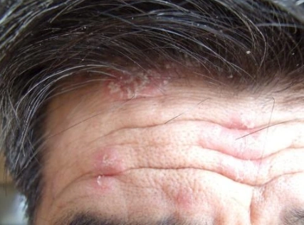 头皮型银屑病图片 (31)_有来医生