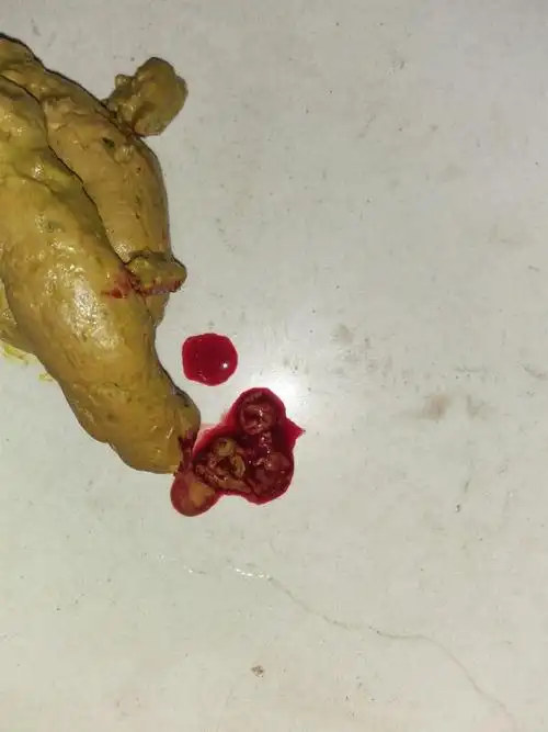 孩子拉屎拉血,看看有没有问题