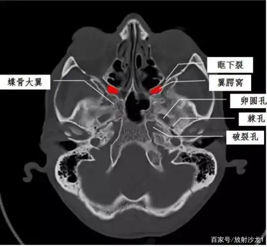 翼腭窝的ct影像解剖