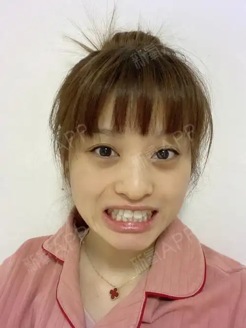 【术前】我的牙齿情况是外翻比较严重,侧面看 就是很_圈子-新氧美容