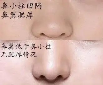如果鼻翼低于鼻小柱,鼻小柱凹陷,鼻翼在视觉上会有过度肥厚的感觉.