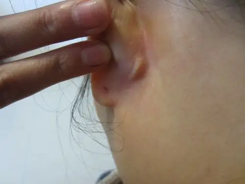 耳朵后面长了一个东西,按一下会疼,不是硬的,但是也不是很软.