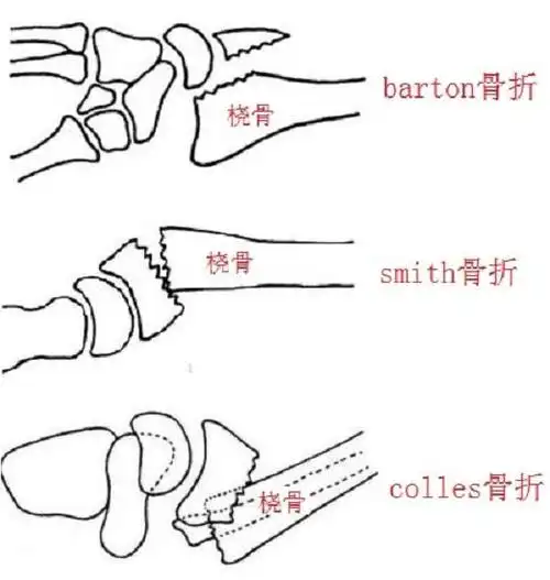 1,伸直型孟氏骨折,即尺骨干上端三分之一部分的骨折,伴桡骨头脱位,多