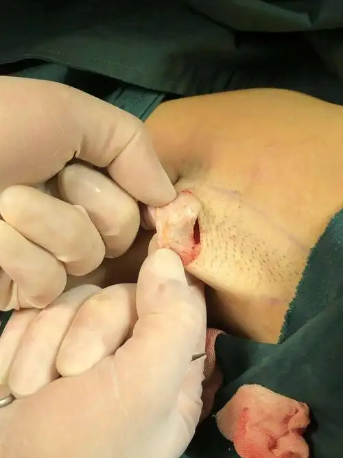 微创腋臭手术~让生活不再尴尬