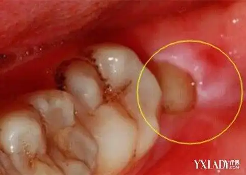 【图】智齿冠周炎自己会好吗 医生建议确诊后应及早治疗