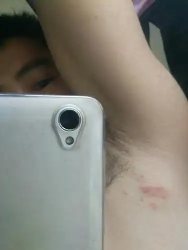 腋下靠后一点,长了一片红疹,动胳膊都疼,是什么问题