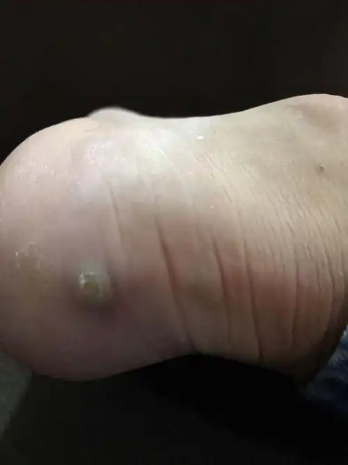 脚后跟长了一颗包 一碰就刺痛刺痛的
