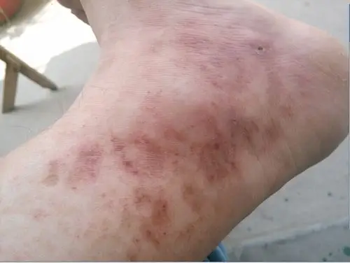 我的脚从小腿至脚踝和脚背都长有像毛细血管网状的红斑.