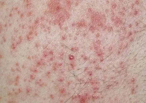 湿疹类型-接触性湿疹症状图片