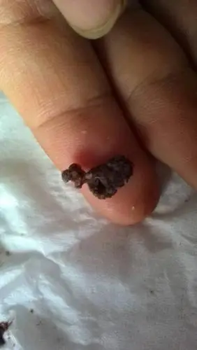 孕期阴痒,大夫让用了邦尔洁褐色水凝胶 每次方便后都有褐色小渣子,用