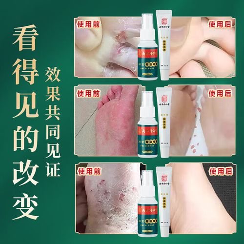乐家老铺脚臭脚痒脱皮脚丫膏止氧净喷剂瓶/30ml 30ml喷剂