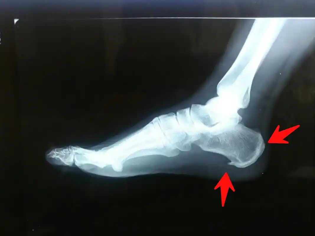 脚后跟骨质增生,请问该怎么治