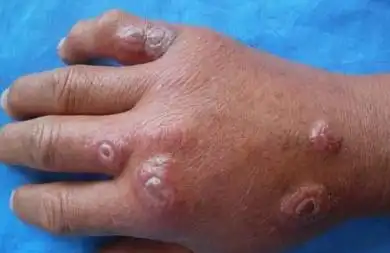 羊痘_治疗_症状_鉴别_羊痘专家免费咨询_快速问医生