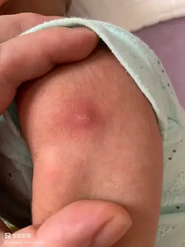 50天宝宝手臂起来个红肿脓包