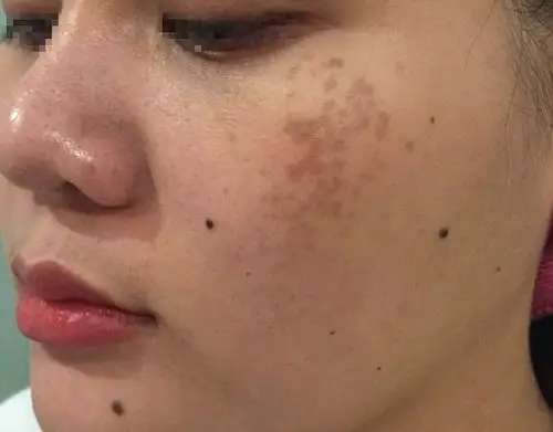 脸上有褐青色痣的同时潜在的黄褐斑该怎么治