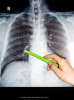 正常的肺部ct扫描照片