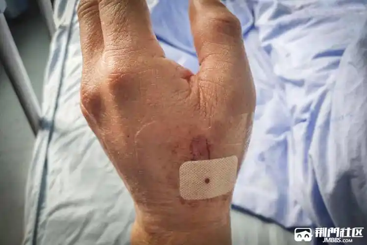 心绞痛,冠心病有奇招:"三种路径"探血管 "舍近求远"优点多