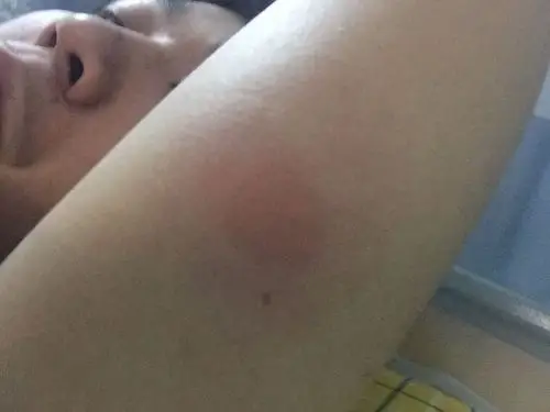 昨天被一只苍蝇大小的虫子叮了一下,就像蜜蜂叮了一下,但不是蜜蜂