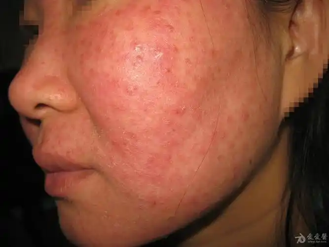 所见最严重的面部蠕型螨皮炎1例