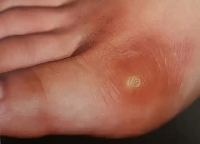 "鸡眼"你真的认识吗?