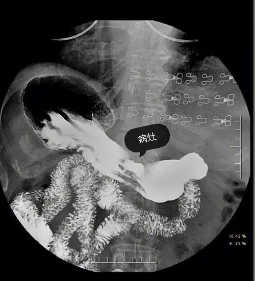 胃体与胃窦交界区胃小弯侧可见一不规则龛影,位于胃轮廓之内,周围见