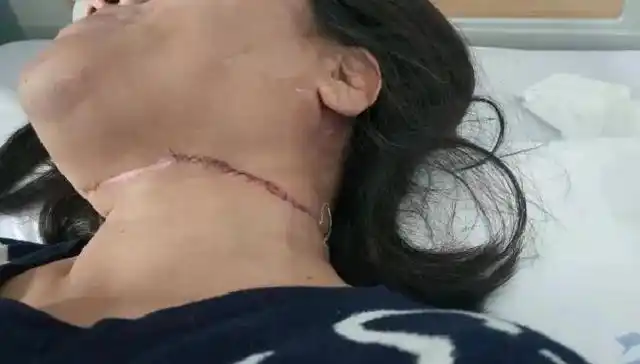 致命风筝线!女子骑车时遭"割喉"伤口长20公分:差点我就没了