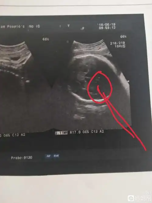 都说b超单上有三条线是女儿,有会看的宝妈