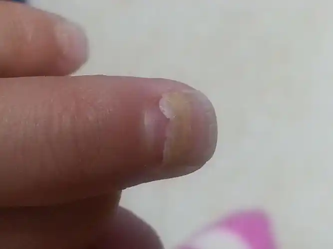 请教大虾,三岁多的小孩儿手指甲盖脱落是怎么回事,拍了几张图,大家