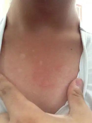 这个白斑是怎么回事.后面也有