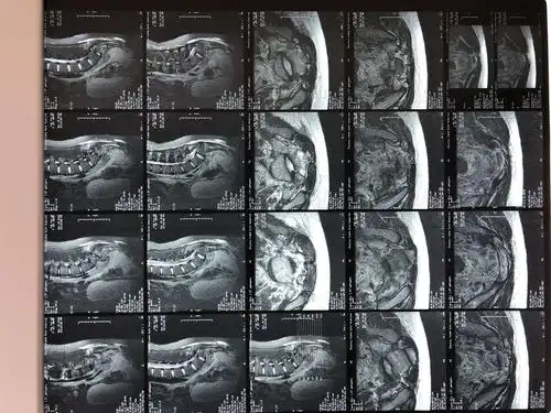 骶骨骨折会诊,分型?手术方案?固定方式?急诊手术还是择期?