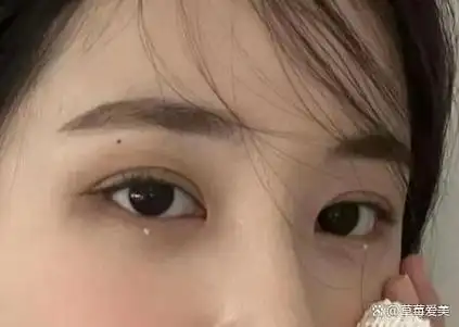 全切双眼皮7毫米恢复后多宽