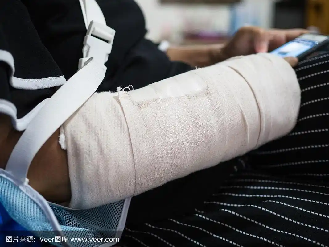 一个骨折的手臂打石膏的特写