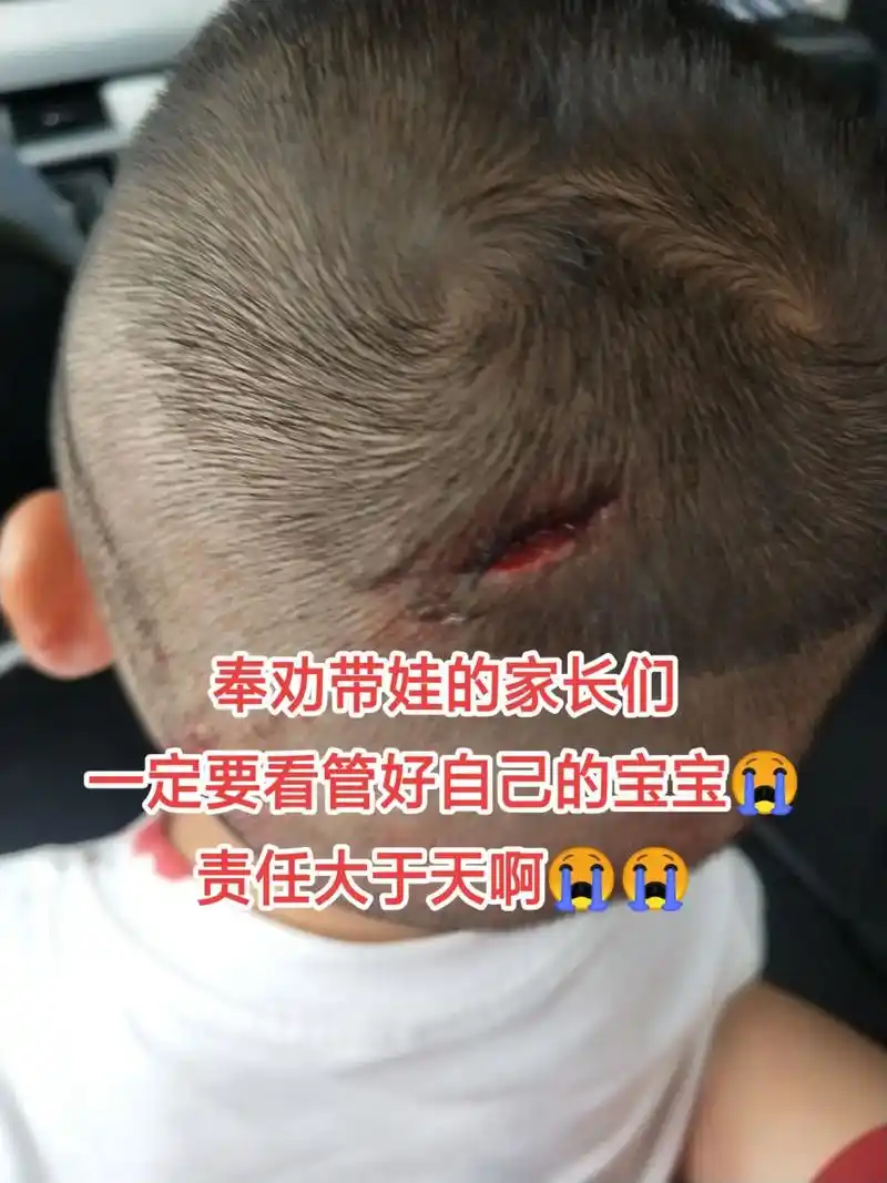 宝贝,还记得上次你摔那一次还是你满岁的头一天,脸擦伤一大部分