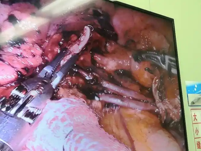 独创:全孔机器人人工气胸下三枪法左肺上叶切除术 - 好大夫在线