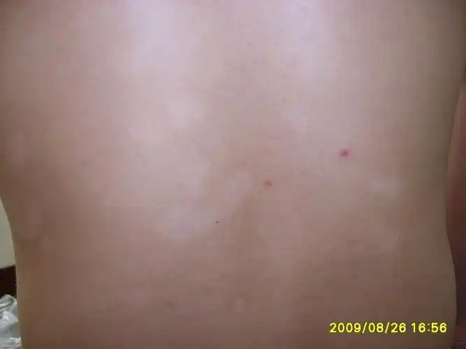 玫瑰糠疹后白斑