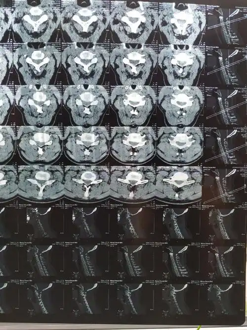 拍的颈椎ct说有一块弯曲了,如何治疗?