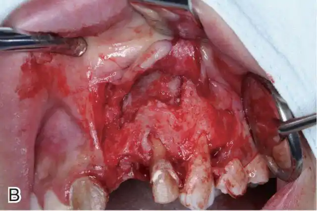 颌骨囊肿中牙和骨组织的处理对策王恩博医师