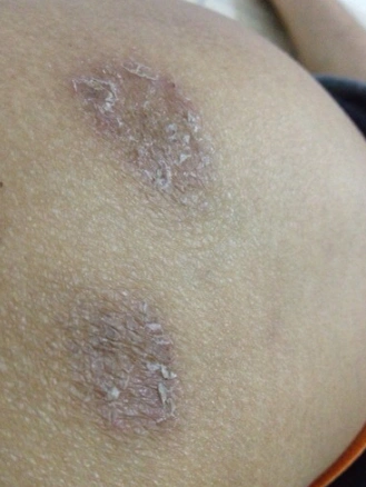 体股癣初期现象图片 (15)