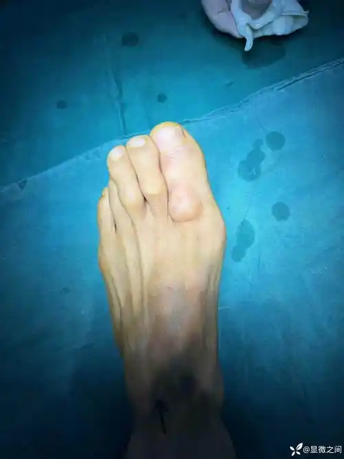 足部腱鞘囊肿一例