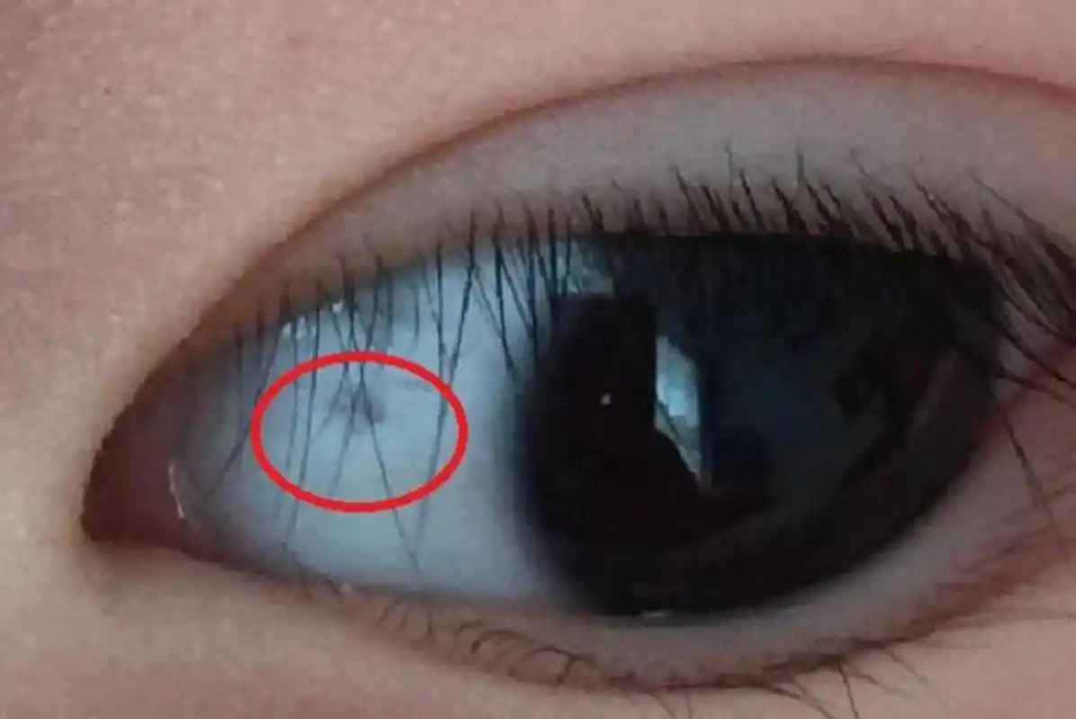 孩子眼球上有个小黑点?北大医师:家长别大意,不单单是色素沉着