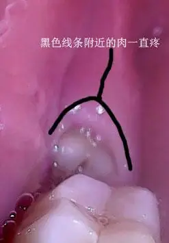 求专业牙医 大牙后面张个牙 一直疼