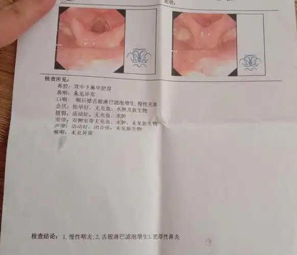 今天我们来说一说滤泡性咽炎,中医上它属于慢性咽炎的其中一类,非常