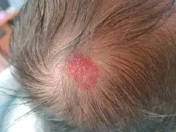 新生儿头顶长了一小块红色斑点