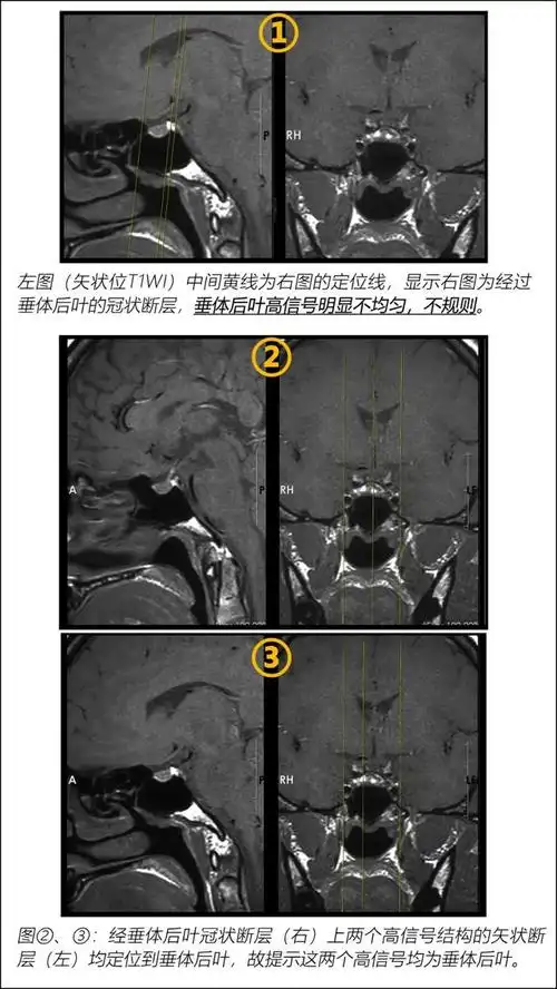 正常垂体的mri表现